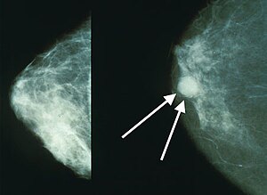 breast cysts hereditary