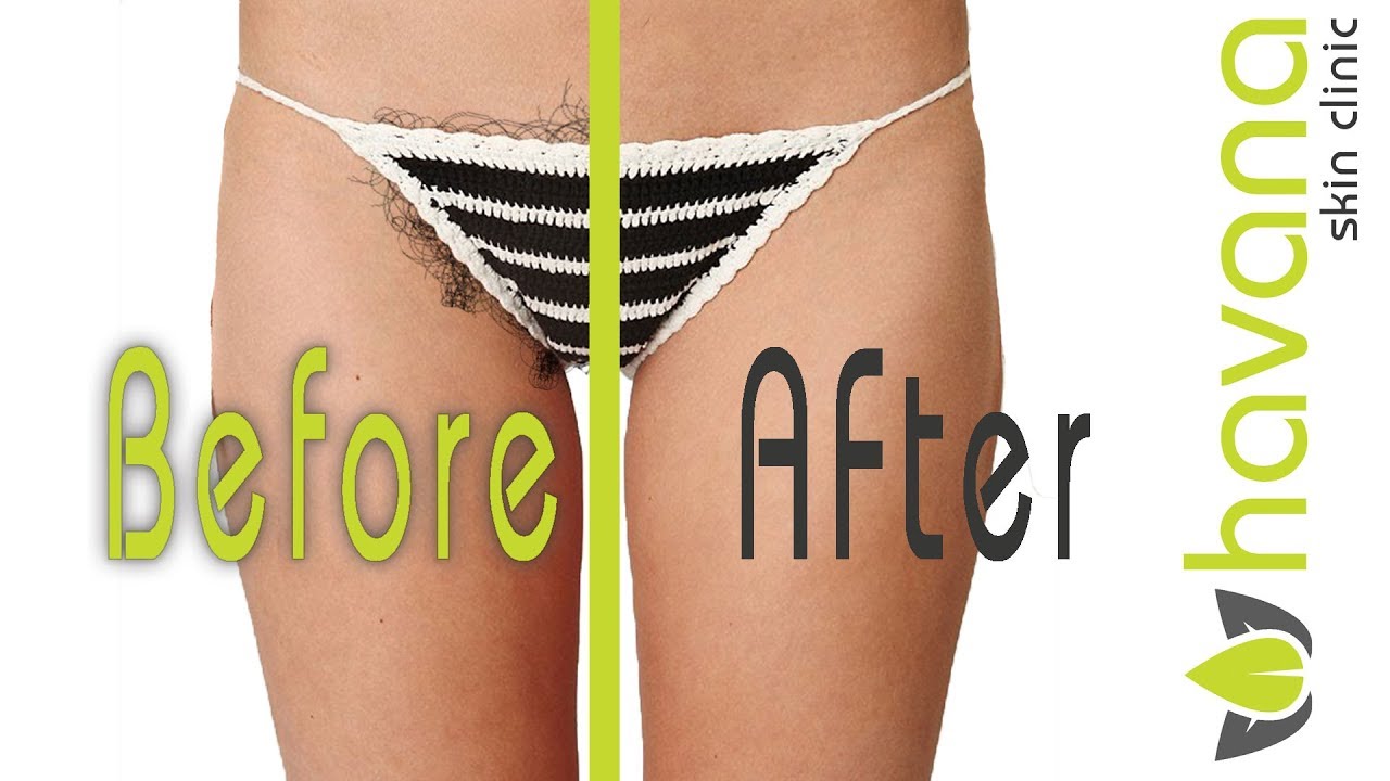 removal bikini hair laser reviews