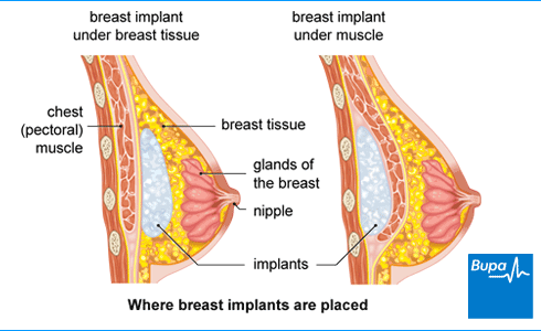 inlargement plans payment breast