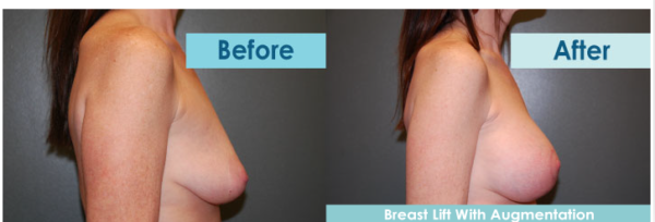 lift procedures newest breast in