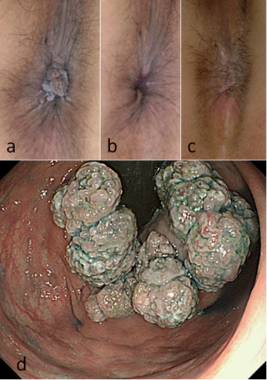 treatment warts for anal