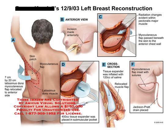 dorsi lattisimus reconstruction breast flap